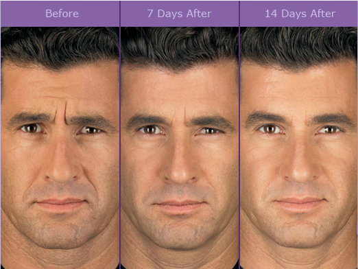 How Will Botox Affect My Skin