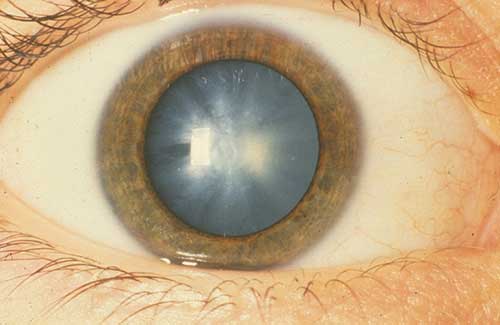 1: What Causes a Cataract?