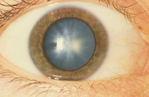 Causes of Cataract