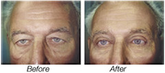 Blepharoplasty/Eyelid Lift Procedure Blepharoplasty or Eyelid Lift
