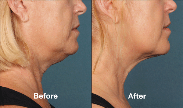 KYBELLA™ Treatment for Double Chin