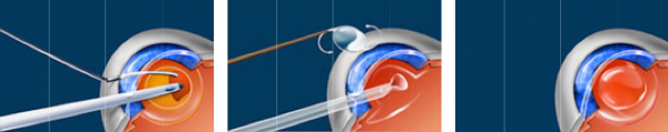 Cataract Surgery Illustration