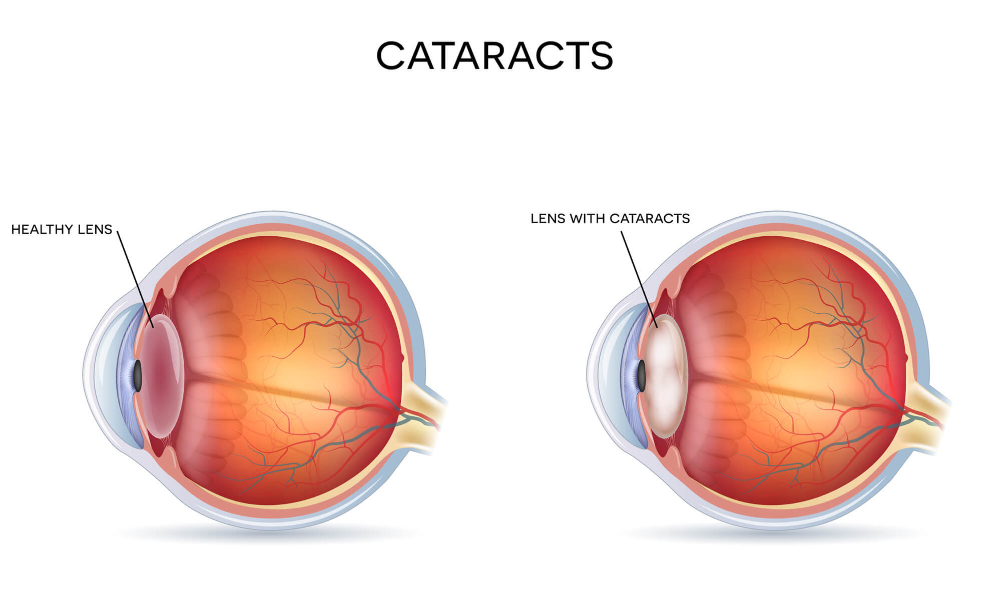 What are Cataracts? 