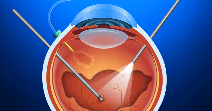 What is a Vitrectomy?