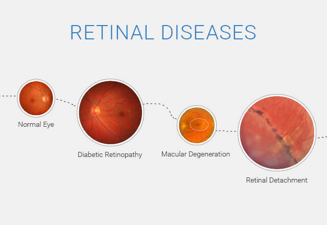 What are retinal diseases