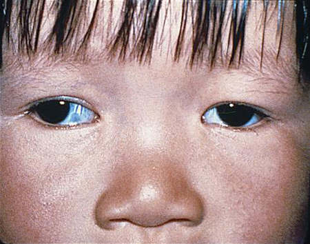 What is Amblyopia? Amblyopia Treatment