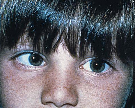 What is Strabismus? Strabismus Treatment in Fort Myers