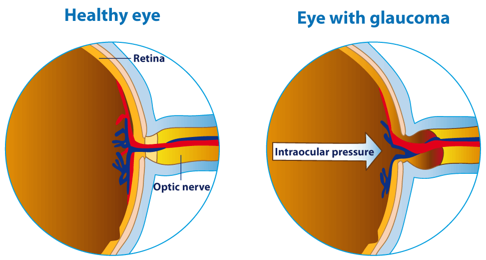 What causes Glaucoma? Symptoms of Glaucoma