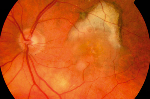 Dry AMD Treatment