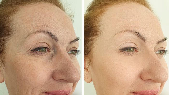 CO2 Laser Resurfacing Benefits Laser Resurfacing Long Term Benefits