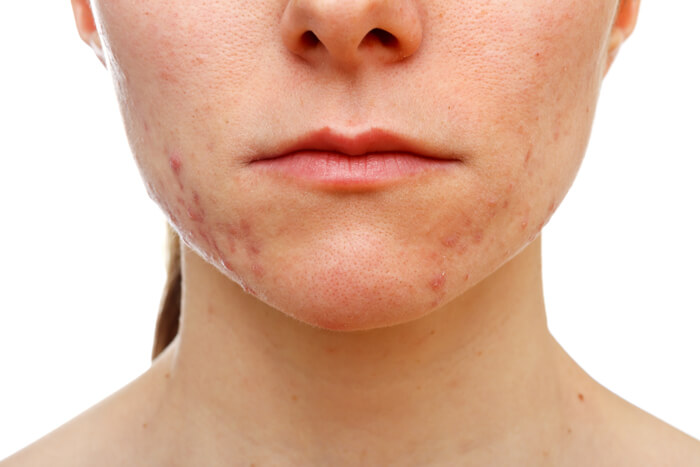 Acne Scar Revision