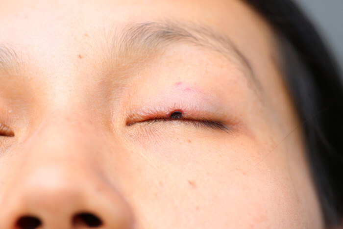 Lesion Removal