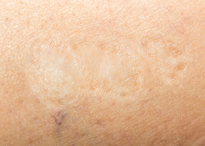 Contracture Scar Revision