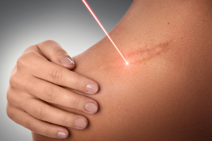 Hypertrophic Scar Revision