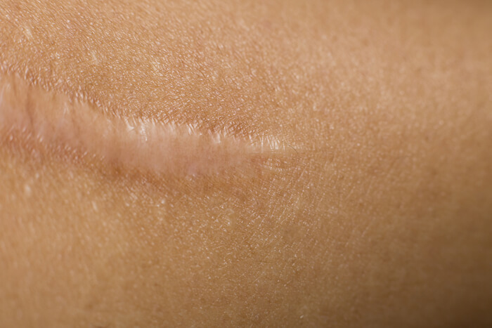Keloid Scars Revision
