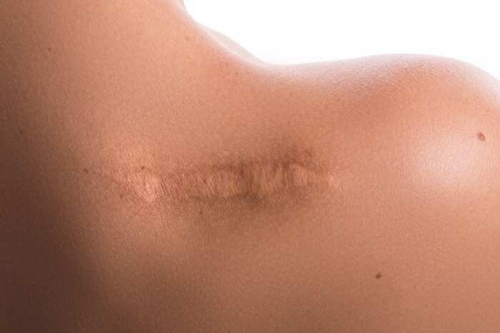 Scar Revision