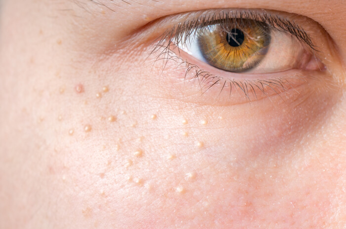 Skin Lesion Types