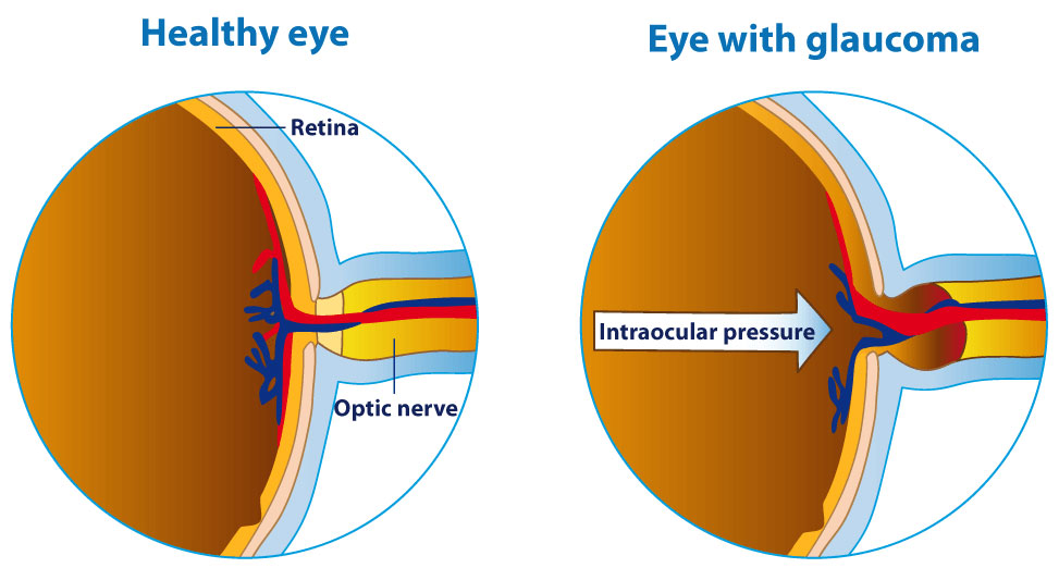 Symptoms of Glaucoma