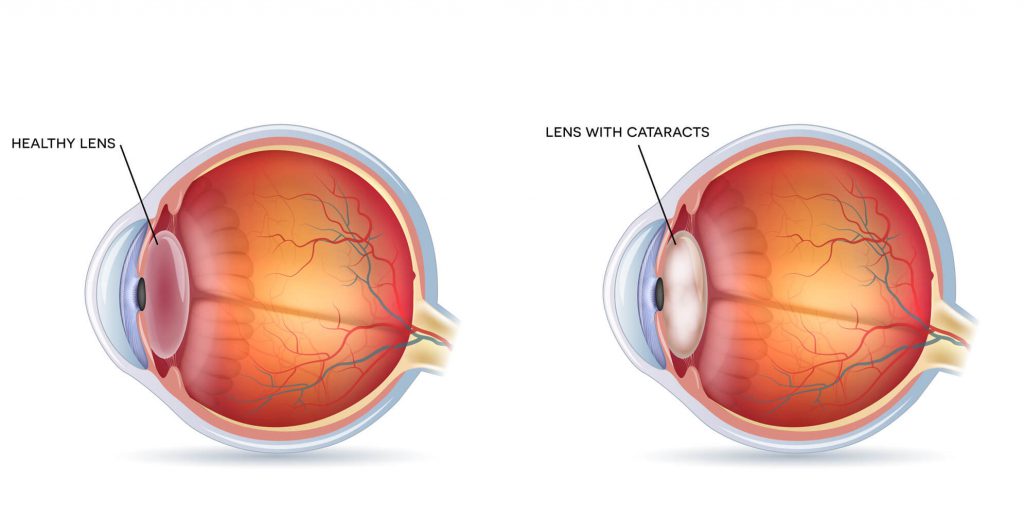 Diagram of cataracts