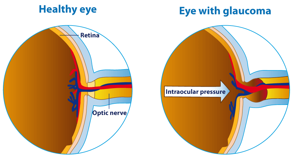 Diagram showing a healthy eye versus an eye with glaucoma.