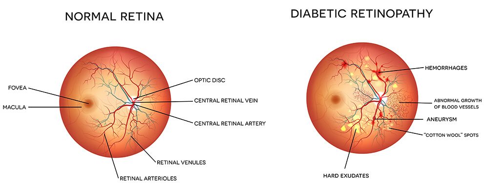 Diagram of diabetic retinopathy vs normal eye